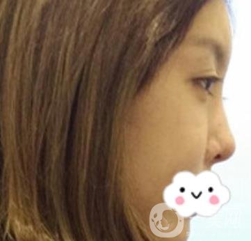 泉州二院整形外科可以打玻尿酸嗎？附價格表及玻尿酸隆鼻案例