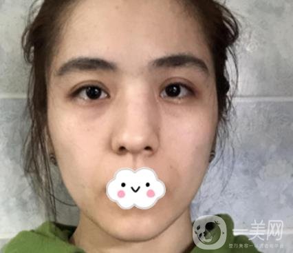 上海伯思立整形怎么樣？附沈國雄隆鼻案例及整形價(jià)格表