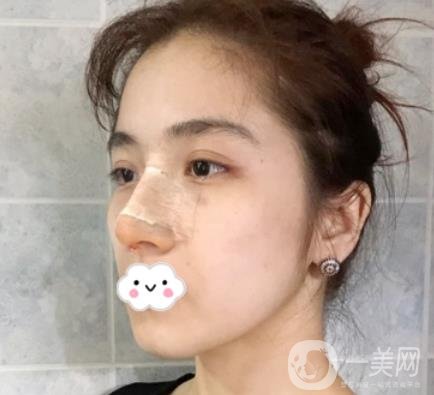 上海伯思立整形怎么樣？附沈國雄隆鼻案例及整形價(jià)格表