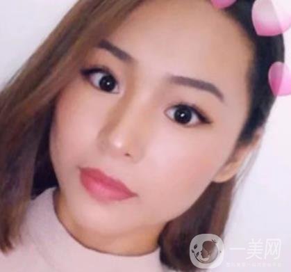 上海九院切下頜角手術(shù)經(jīng)歷分享，附2020整形價格一覽表