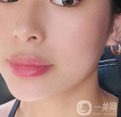 上海九院切下頜角手術(shù)經(jīng)歷分享，附2020整形價格一覽表