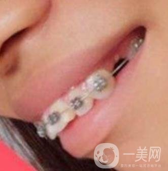 長(zhǎng)征醫(yī)院 整牙