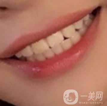 長(zhǎng)征醫(yī)院 整牙