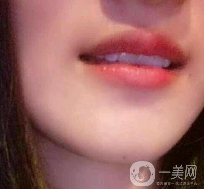 北京市海淀醫(yī)院整牙多少錢？看價格表及案例*果