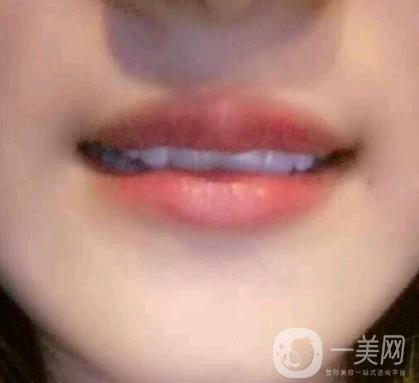 北京市海淀醫(yī)院整牙多少錢？看價格表及案例*果