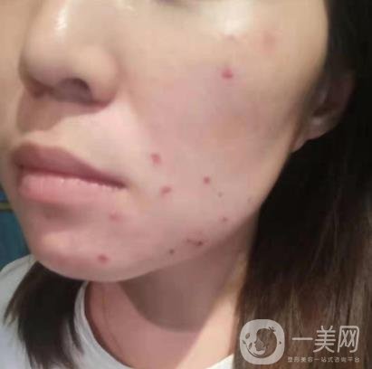 吉大一院整形美容科價格表費用明細，附祛斑案例