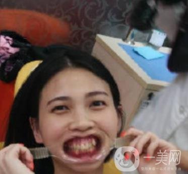 南昌大學(xué)第二附屬醫(yī)院整牙60天案例，還有價(jià)格表哦