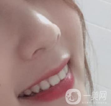 南昌大學(xué)第二附屬醫(yī)院整牙60天案例，還有價(jià)格表哦