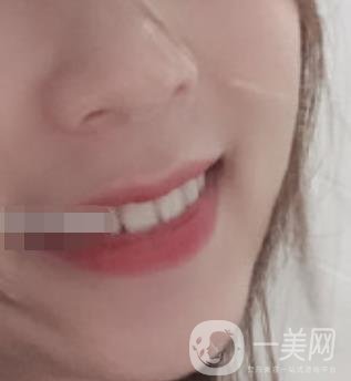 南昌大學(xué)第二附屬醫(yī)院整牙60天案例，還有價(jià)格表哦