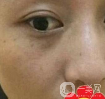 南方醫(yī)科大學(xué)南方醫(yī)院祛斑*果咋樣_案例_價(jià)格表