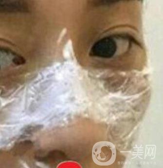 南方醫(yī)科大學(xué)南方醫(yī)院祛斑*果咋樣_案例_價(jià)格表