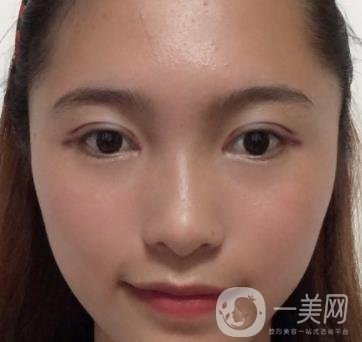 沈陽軍區(qū)總醫(yī)院整形外科價(jià)格表2020，附雙眼皮案例