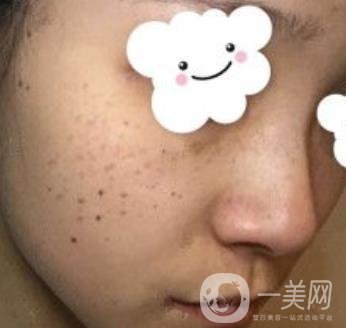 浙二醫(yī)院整形美容科價格表*新版，附激光祛斑*終*果圖