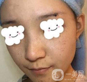 浙二醫(yī)院整形美容科價格表*新版，附激光祛斑*終*果圖