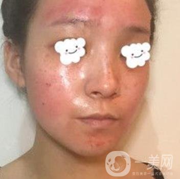 浙二醫(yī)院整形美容科價格表*新版，附激光祛斑*終*果圖