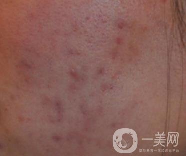 南通維多利亞美容醫(yī)院怎么樣?價格表收費項目和祛痘*果實拍圖