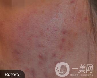 南通維多利亞美容醫(yī)院怎么樣?價格表收費項目和祛痘*果實拍圖