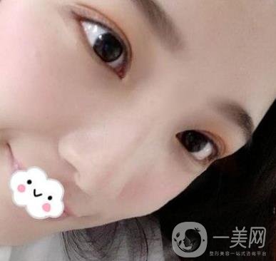 北京安貞醫(yī)院整容怎么樣？李斌斌修復雙眼皮怎么樣？內(nèi)含案例及價格表