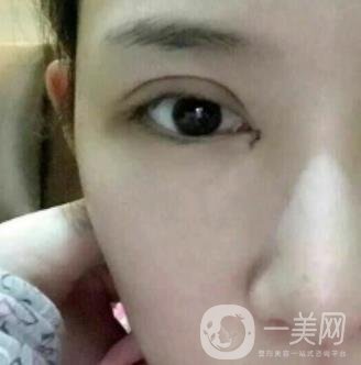 北京克萊美舍張冰潔雙眼皮評價怎么樣？案例及價格表一覽