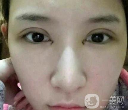 北京克萊美舍張冰潔雙眼皮評價怎么樣？案例及價格表一覽