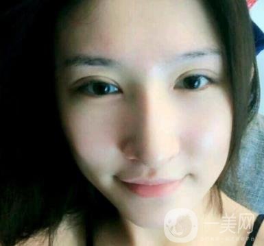 北京克萊美舍張冰潔雙眼皮評價怎么樣？案例及價格表一覽