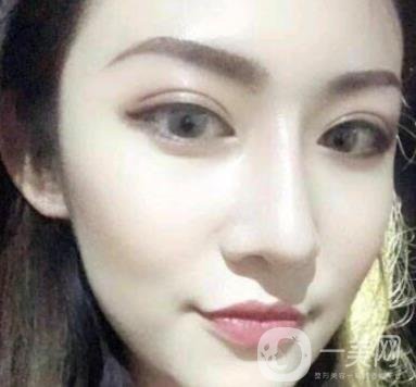 北京克萊美舍張冰潔雙眼皮評價怎么樣？案例及價格表一覽