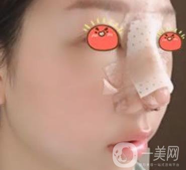 廣東省人民醫(yī)院隆鼻案例及整形價格表分享