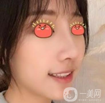 廣東省人民醫(yī)院隆鼻案例及整形價格表分享