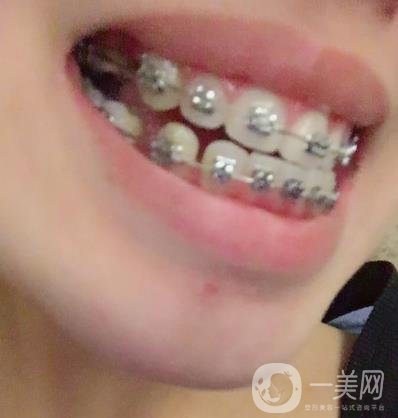 北大第三醫(yī)院整牙