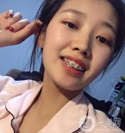 北大第三醫(yī)院整牙