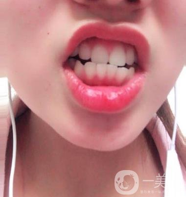 北大第三醫(yī)院整牙