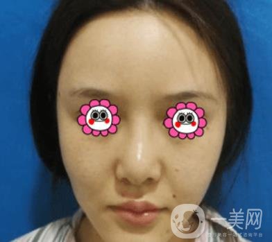 長沙中南大學(xué)*三醫(yī)院整形美容外科隆鼻多少錢？價(jià)格表及案例詳情