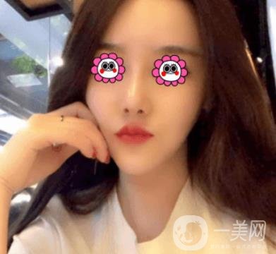 長沙中南大學(xué)*三醫(yī)院整形美容外科隆鼻多少錢？價(jià)格表及案例詳情