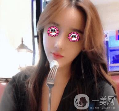 長沙中南大學(xué)*三醫(yī)院整形美容外科隆鼻多少錢？價(jià)格表及案例詳情