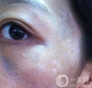 解放軍總醫(yī)院整形美容科*新價(jià)格表發(fā)布,附祛斑案例日記分享