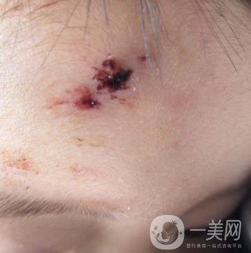 泰安市中心醫(yī)院美容整形科價(jià)格表,附祛疤案例*果分享