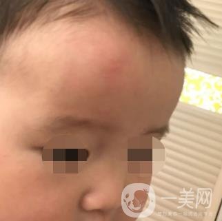 泰安市中心醫(yī)院美容整形科價(jià)格表,附祛疤案例*果分享