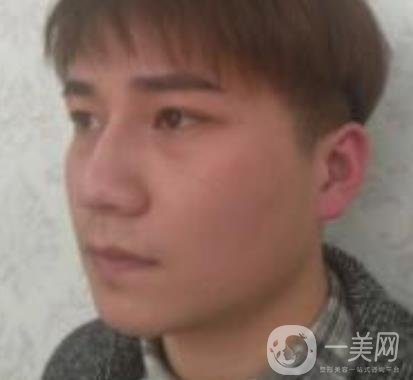 棗莊市立醫(yī)院燒傷整形美容科做光子嫩膚好嗎？價(jià)格表及術(shù)后*果分享