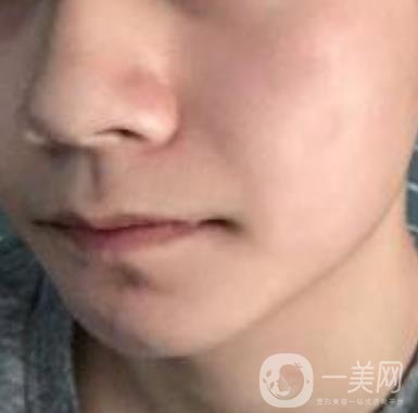 棗莊市立醫(yī)院燒傷整形美容科做光子嫩膚好嗎？價(jià)格表及術(shù)后*果分享