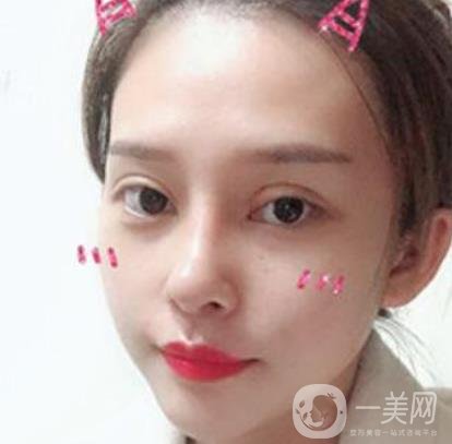 臨沂市人民醫(yī)院價格表2020_雙眼皮案例分享