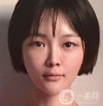 石家莊市醫(yī)院整形美容外科價格表2020，附雙眼皮實例