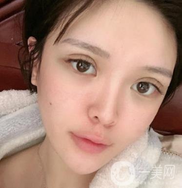 石家莊市醫(yī)院整形美容外科價格表2020，附雙眼皮實例