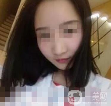 邢臺(tái)市人民醫(yī)院美容科陳譽(yù)華*案例_價(jià)格表明細(xì)