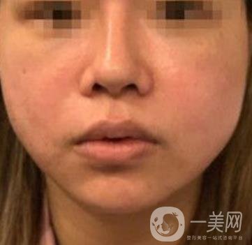 四川省人民醫(yī)院整形外科游曉波磨骨怎么樣?價格收費明細(xì)表一覽