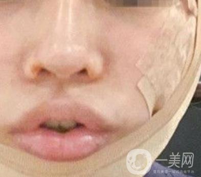 四川省人民醫(yī)院整形外科游曉波磨骨怎么樣?價格收費明細(xì)表一覽