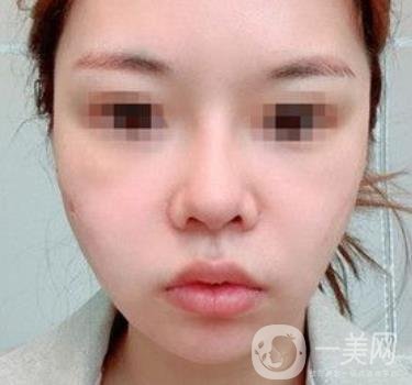 四川省人民醫(yī)院整形外科游曉波磨骨怎么樣?價格收費明細(xì)表一覽