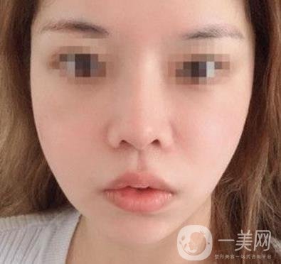 四川省人民醫(yī)院整形外科游曉波磨骨怎么樣?價格收費明細(xì)表一覽