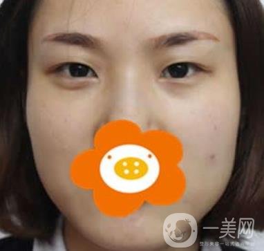 成都*做雙眼皮前后*果圖，附整形美容科價格收費(fèi)表一覽