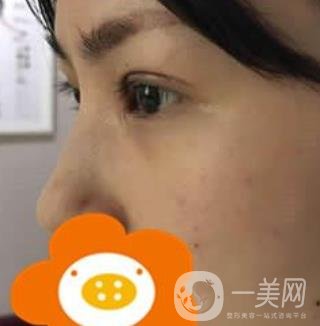 成都*做雙眼皮前后*果圖，附整形美容科價格收費(fèi)表一覽