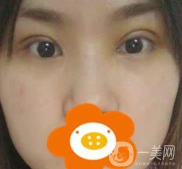 成都*做雙眼皮前后*果圖，附整形美容科價格收費(fèi)表一覽